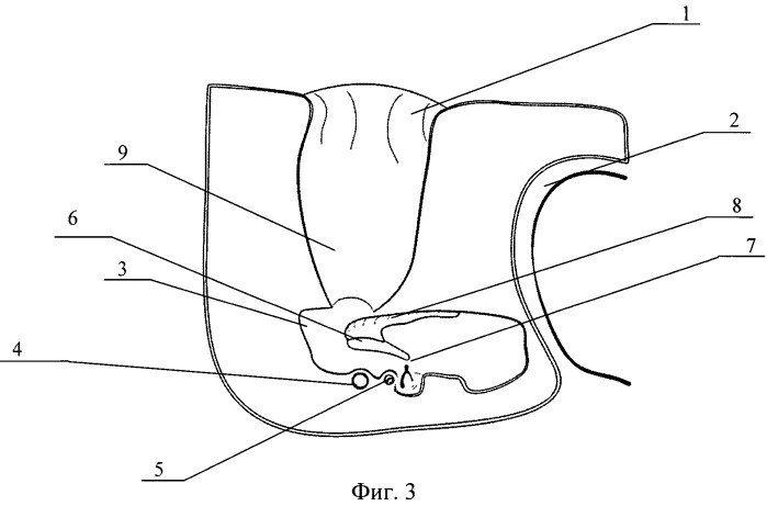 Способ профилактики вибротравмы внутреннего уха при удалении атрезии наружного слухового прохода (патент 2465875)