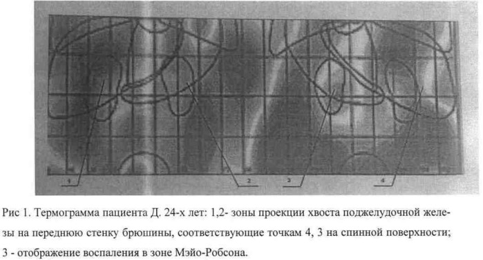 Способ исследования температурного режима поджелудочной железы при диагностике сахарного диабета 1-го типа (патент 2514529)
