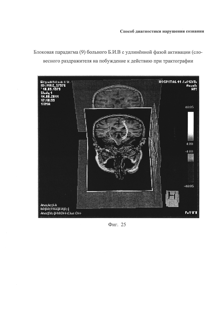 Способ диагностики нарушения сознания (патент 2596049)