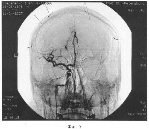 Способ церебральной ангиографии (патент 2348359)