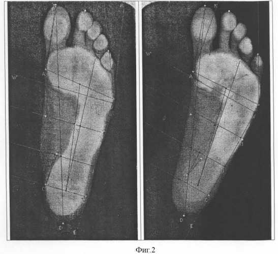 Способ определения анатомофункционального состояния стоп (патент 2309663)
