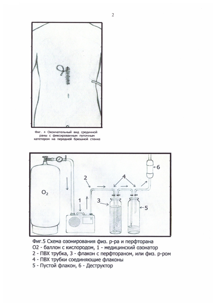Способ внутрипортальной озонотерапии при распространенном перитоните (патент 2594512)