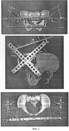 Способ лечения переломов и разрывов тазового кольца с вертикальным и ротационным смещением (патент 2277876)