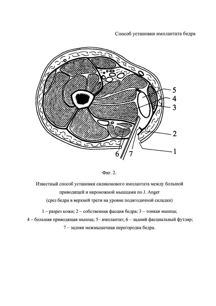 Способ установки имплантата бедра (патент 2626271)
