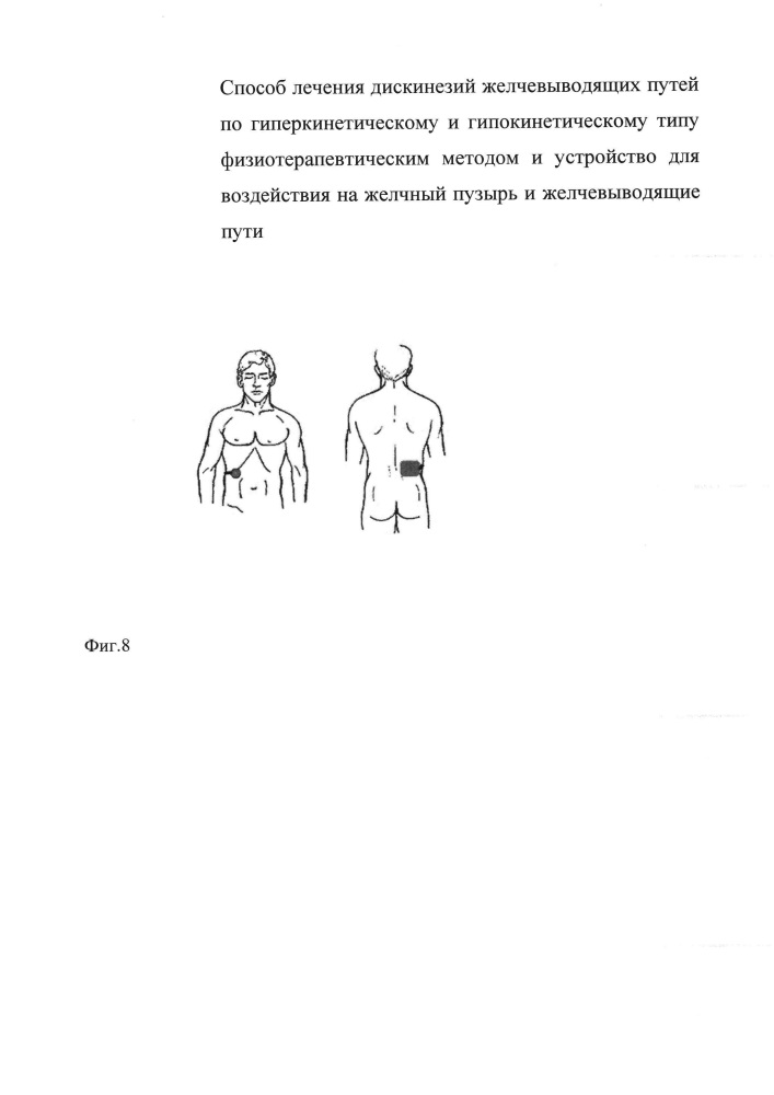 Способ лечения дискинезий желчевыводящих путей по гиперкинетическому и гипокинетическому типам физиотерапевтическим методом и устройство для воздействия на желчный пузырь и желчевыводящие пути (патент 2659146)