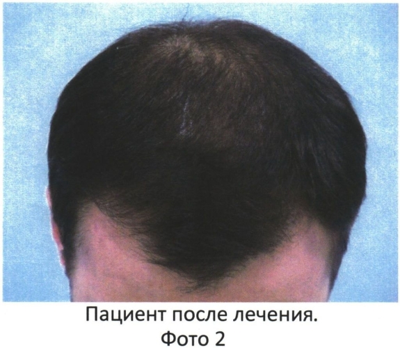 Способ трансплантации волос (патент 2550428)