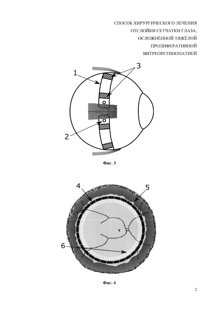 Способ хирургического лечения отслойки сетчатки глаза, осложнённой тяжёлой пролиферативной витреоретинопатией (патент 2628652)