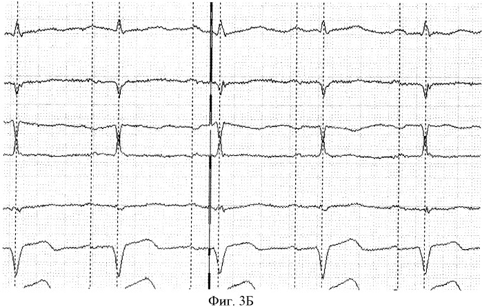Способ выделения начала кардиоцикла (патент 2366358)