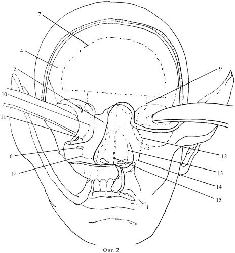 Способ доступа при операциях по поводу опухолей полости носа и центральной части основания черепа (патент 2408293)