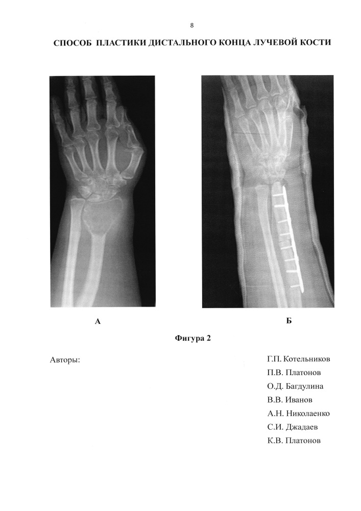 Способ пластики дистального конца лучевой кости (патент 2607567)