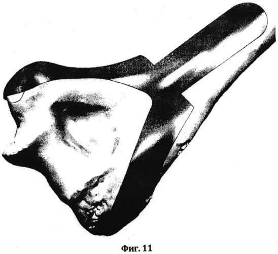 Способ проектирования индивидуальных имплантатов для остеосинтеза переломов длинных трубчатых костей (патент 2551304)