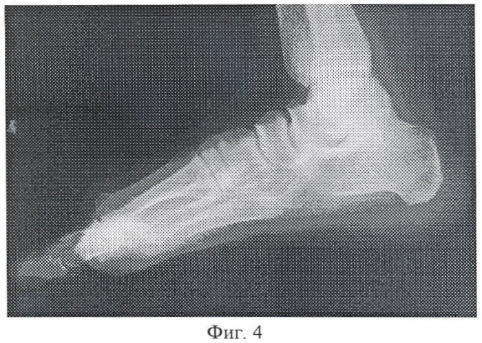 Способ оперативной коррекции деформаций стопы (патент 2412661)