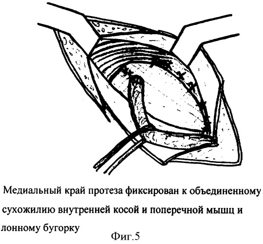 Способ герниопластики при паховых грыжах (патент 2338467)