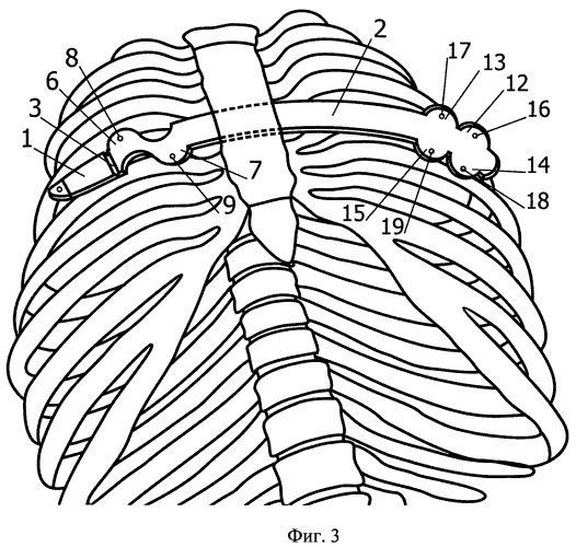 Способ хирургического лечения воронкообразной деформации грудной клетки и устройство для его осуществления (патент 2496438)
