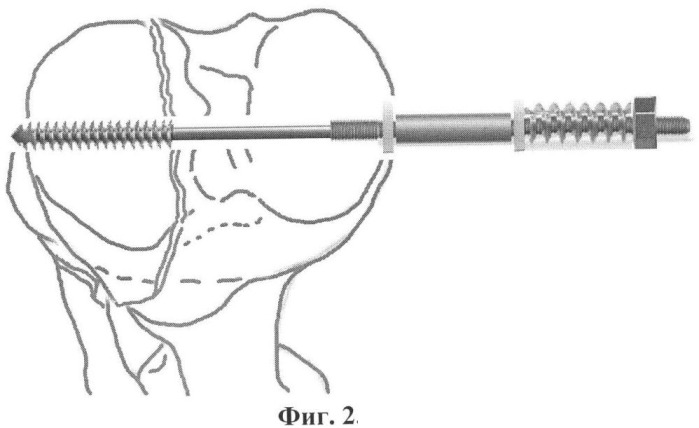 Устройство для остеосинтеза (патент 2345731)