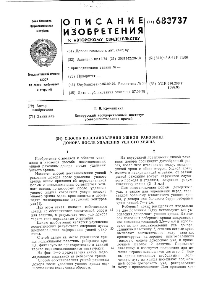 Способ восстановления ушной раковины донора после удаления ушного хряща (патент 683737)
