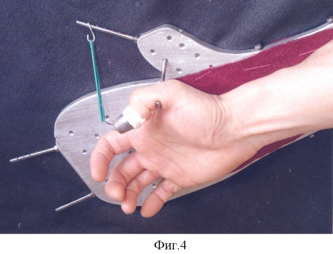 Устройство для восстановления функции пальцев кисти (патент 2324465)