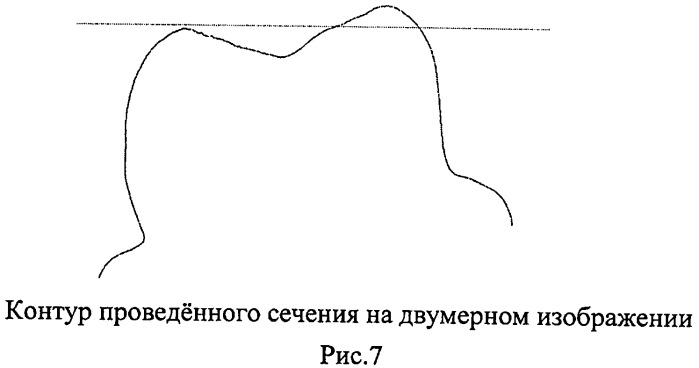 Способ контроля препарирования окклюзионной поверхности зубов при ортопедическом лечении несъемными протезами (патент 2396921)