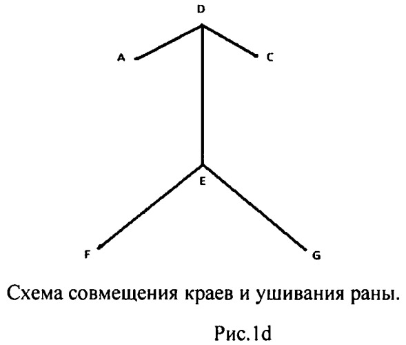 Способ пластического замещения дефектов кожи двумя смежными ротационными лоскутами (патент 2460472)