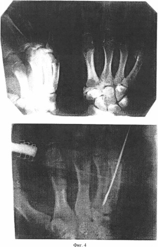 Репонирующее устройство для лечения переломов трубчатых костей кистей и стоп (патент 2332952)