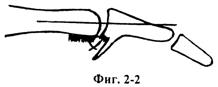 Способ лечения разгибательной контрактуры пальца в проксимальном межфаланговом суставе (патент 2464947)