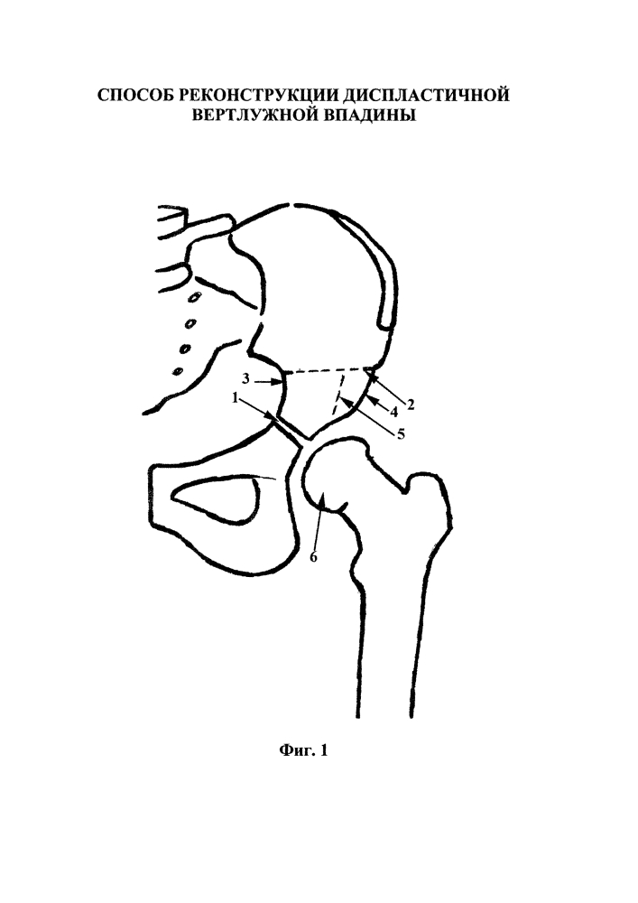 Способ реконструкции диспластичной вертлужной впадины (патент 2609283)