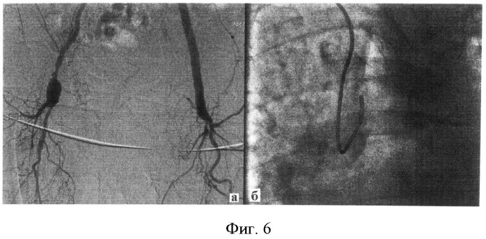 Способ трансвенозного транссептального доступа к артериям головы и шеи (патент 2526464)