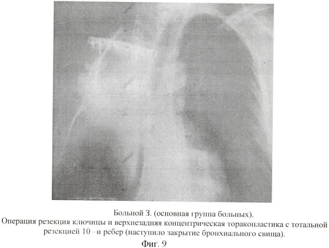Способ хирургического лечения туберкулеза легких (патент 2417762)