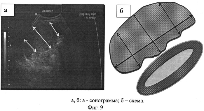 Способ ультразвуковой диагностики воспалительных изменений печени и селезенки при туберкулезе у детей (патент 2535613)
