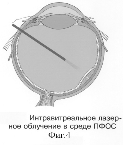 Способ электрохимической деструкции, хирургического удаления и фотодинамической профилактики рецидивов внутриглазных новообразований в среде перфторорганического соединения (варианты) (патент 2244533)