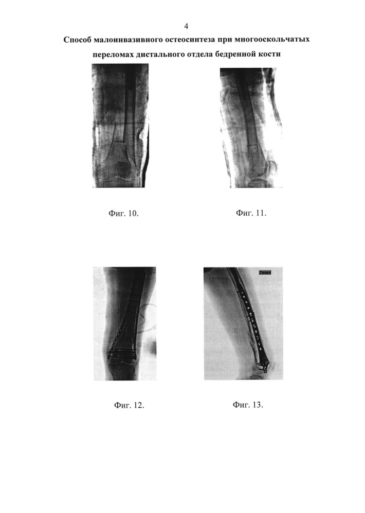 Способ малоинвазивного остеосинтеза при многооскольчатых переломах дистального отдела бедренной кости (патент 2665158)