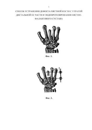 Способ устранения дефекта пястной кости с утратой дистальной ее части и эндопротезирования пястно-фалангового сустава (патент 2578839)