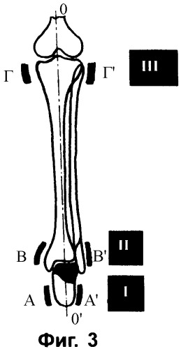 Способ проведения управляемой неинвазивной закрытой аппаратной репозиции и фиксации переломовывихов в затвердевающей повязке (патент 2363406)