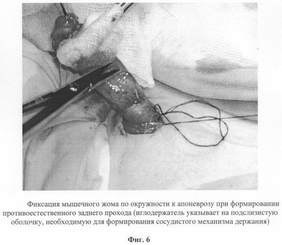 Способ восстановления сосудистого механизма держания при формировании искусственного заднего прохода (патент 2292846)