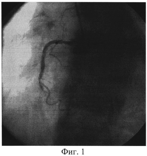 Способ эндоваскулярной коррекции феномена "no-reflow" у пациентов с острым коронарным синдромом с подъемом сегмента st при проведении первичного чрескожного коронарного вмешательства инфаркт-зависимой артерии (патент 2574123)
