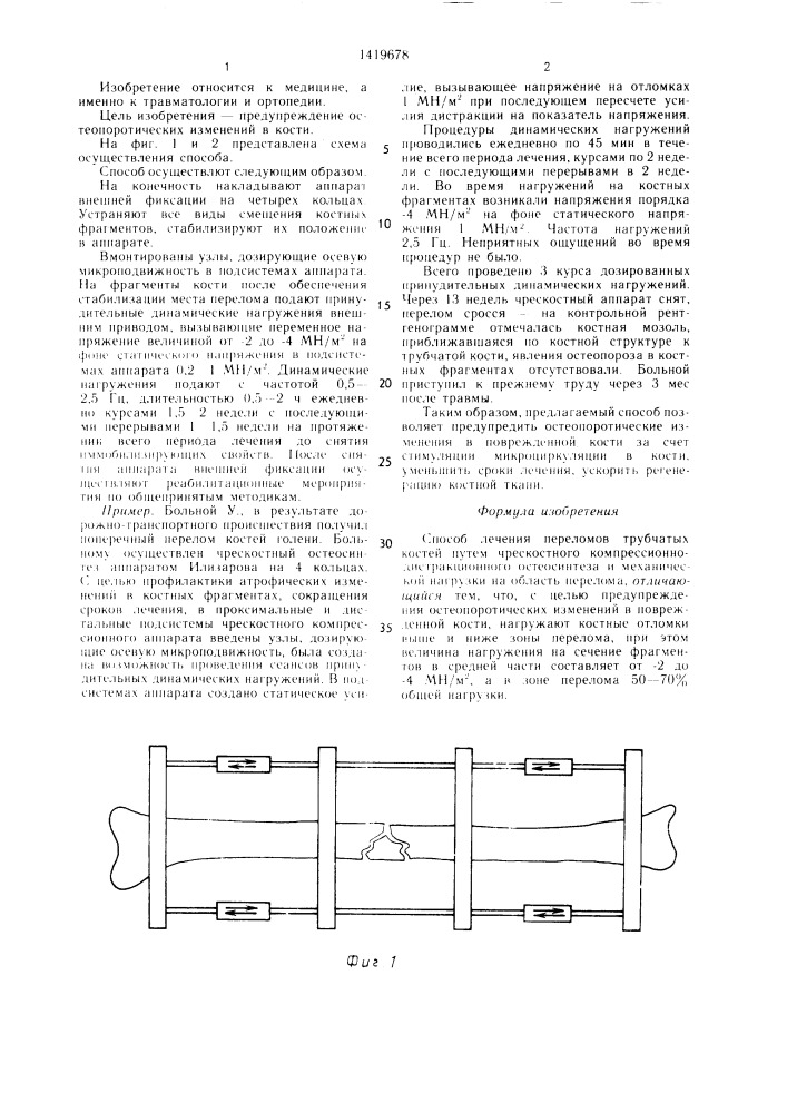 Способ лечения переломов трубчатых костей (патент 1419678)