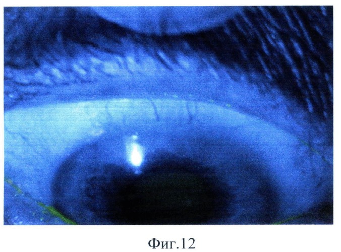 Способ определения степени блефароконъюнктивальной формы синдрома сухого глаза (патент 2500340)