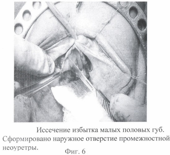 Способ маскулинизирующей уретропластики при лечении транссексуализма (патент 2371115)