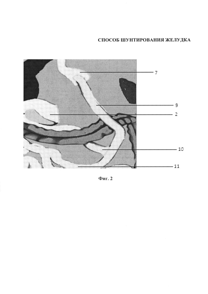 Способ шунтирования желудка (патент 2616988)