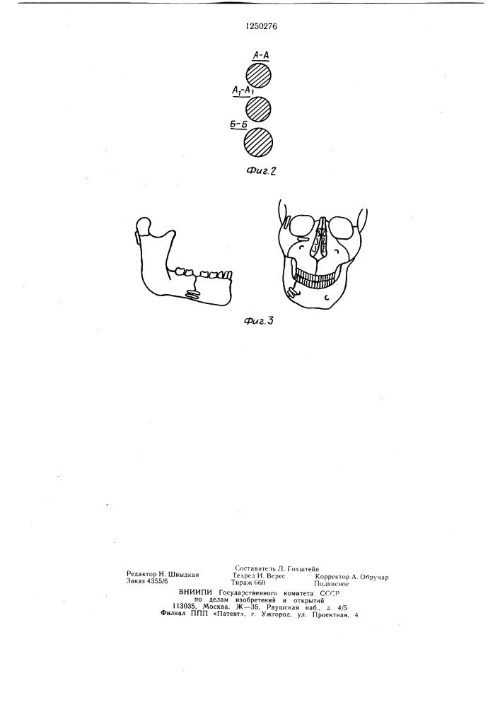Устройство для остеосинтеза костей лицевого скелета (патент 1250276)