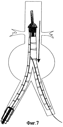 Эндоваскулярный бифуркационный имплантируемый протез (патент 2314778)