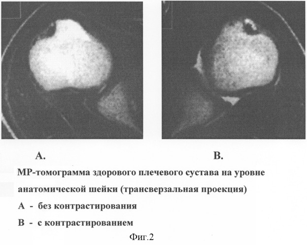 Способ диагностики нестабильности плечевого сустава (патент 2277852)