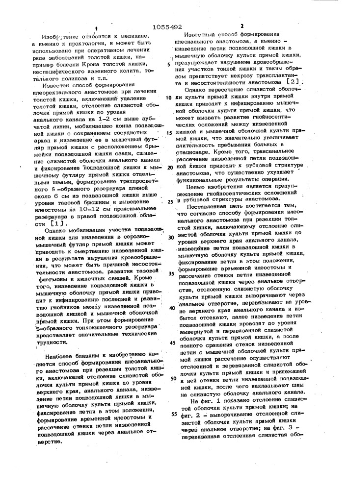 Способ формирования илеоанального анастомоза при резекции толстой кишки (патент 1055492)