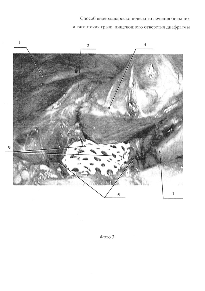 Способ видеолапароскопического лечения больших и гигантских грыж пищеводного отверстия диафрагмы (патент 2627601)