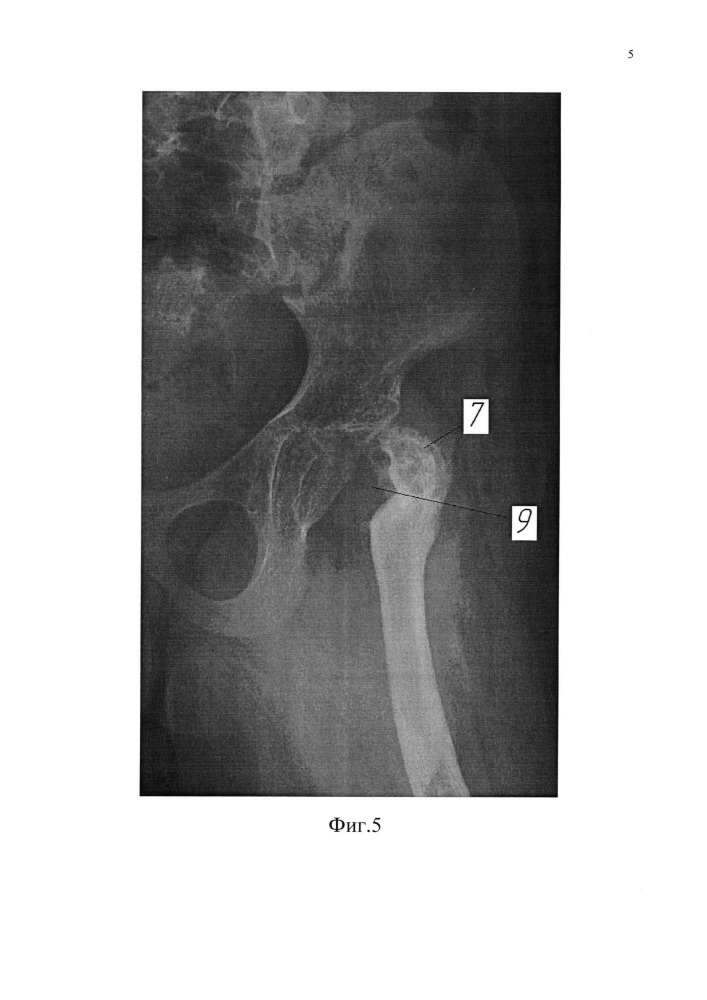 Способ лечения дефекта проксимального отдела бедра (патент 2621538)