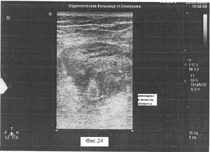 Способ диагностики воспалительных форм острого аппендицита (патент 2318442)