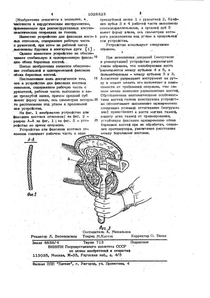 Устройство для фиксации костных отломков (патент 1028323)