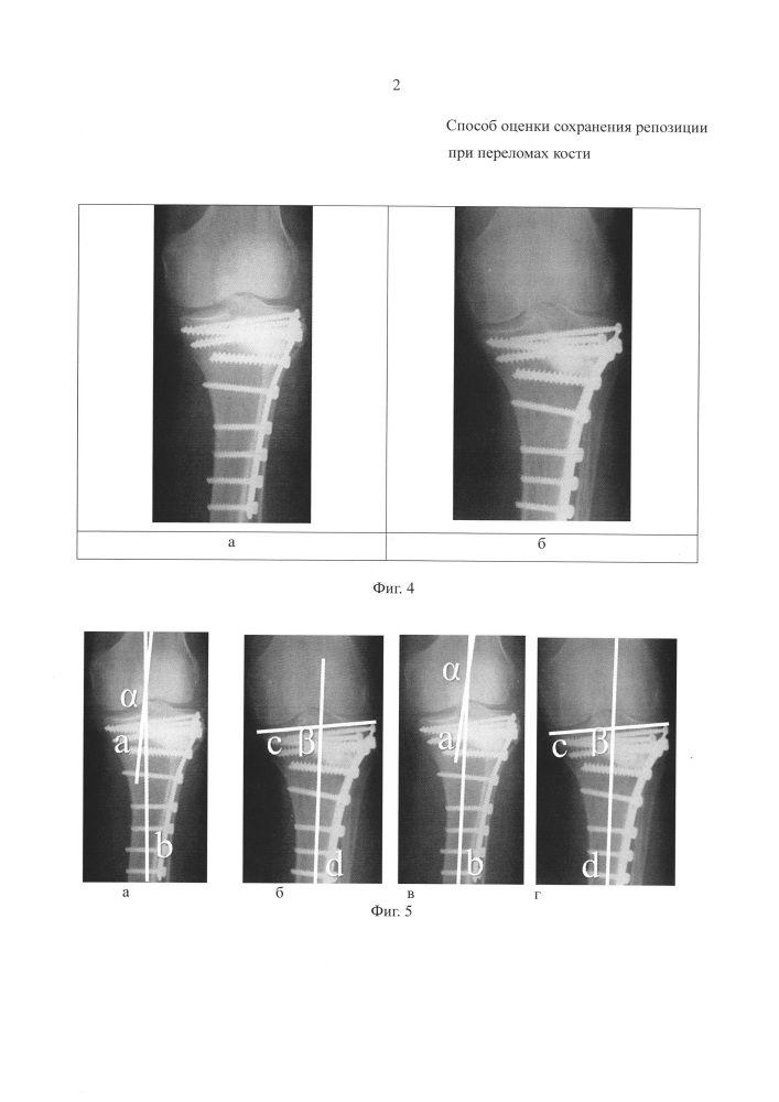 Способ оценки сохранения репозиции переломов костей (патент 2626375)