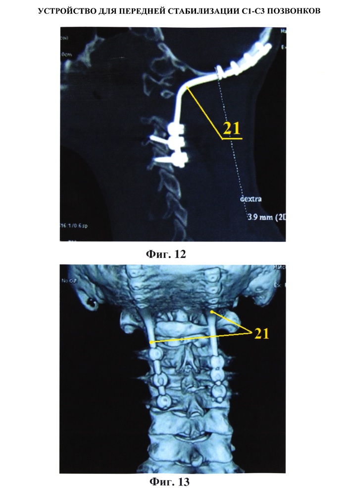Устройство для передней стабилизации с1-с3 позвонков (патент 2615901)