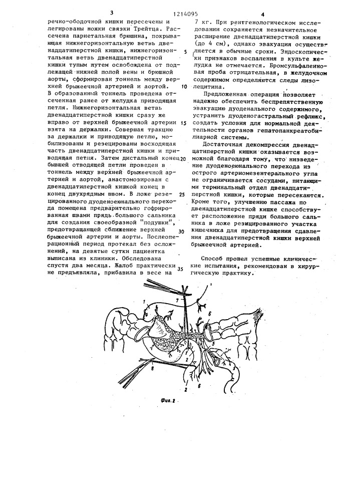 Способ лечения дуоденостаза (патент 1214095)